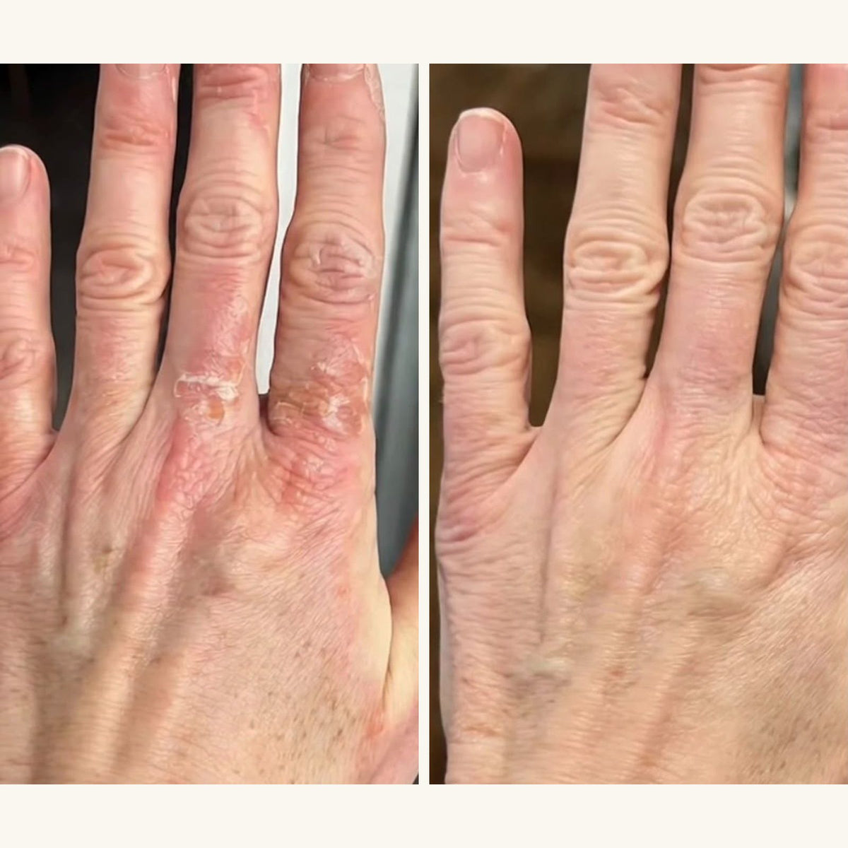 Eczama Balm 40ml – pre i posle (prsti)